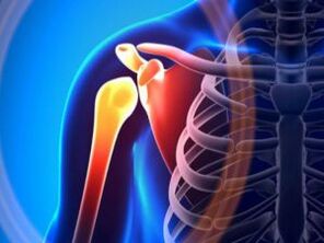 Iekaisusi pleca locītava artrozes dēļ - hroniska muskuļu un skeleta sistēmas slimība