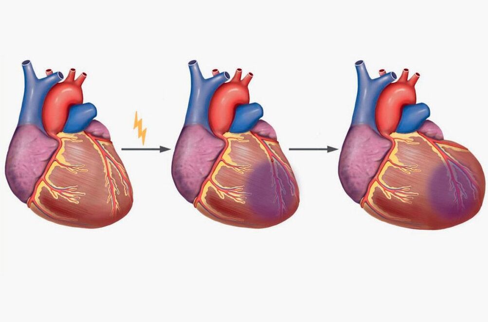 Miokarda infarkts izraisa sāpes plecu lāpstiņās