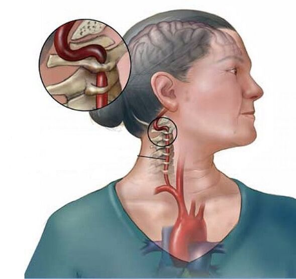 mugurkaula artērijas sindroms ar dzemdes kakla osteohondrozi