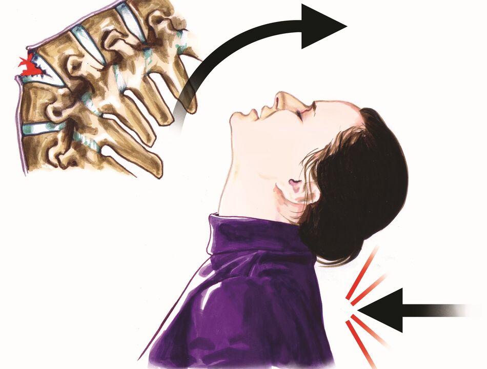 mugurkaula bojājumi kā kakla sāpju cēlonis