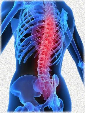 osteohondroze un tās ārstēšanas metodes